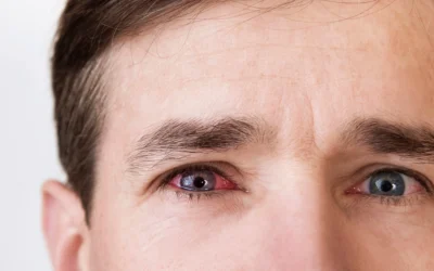 Recognizing and Managing Dry Eye Symptoms Early 