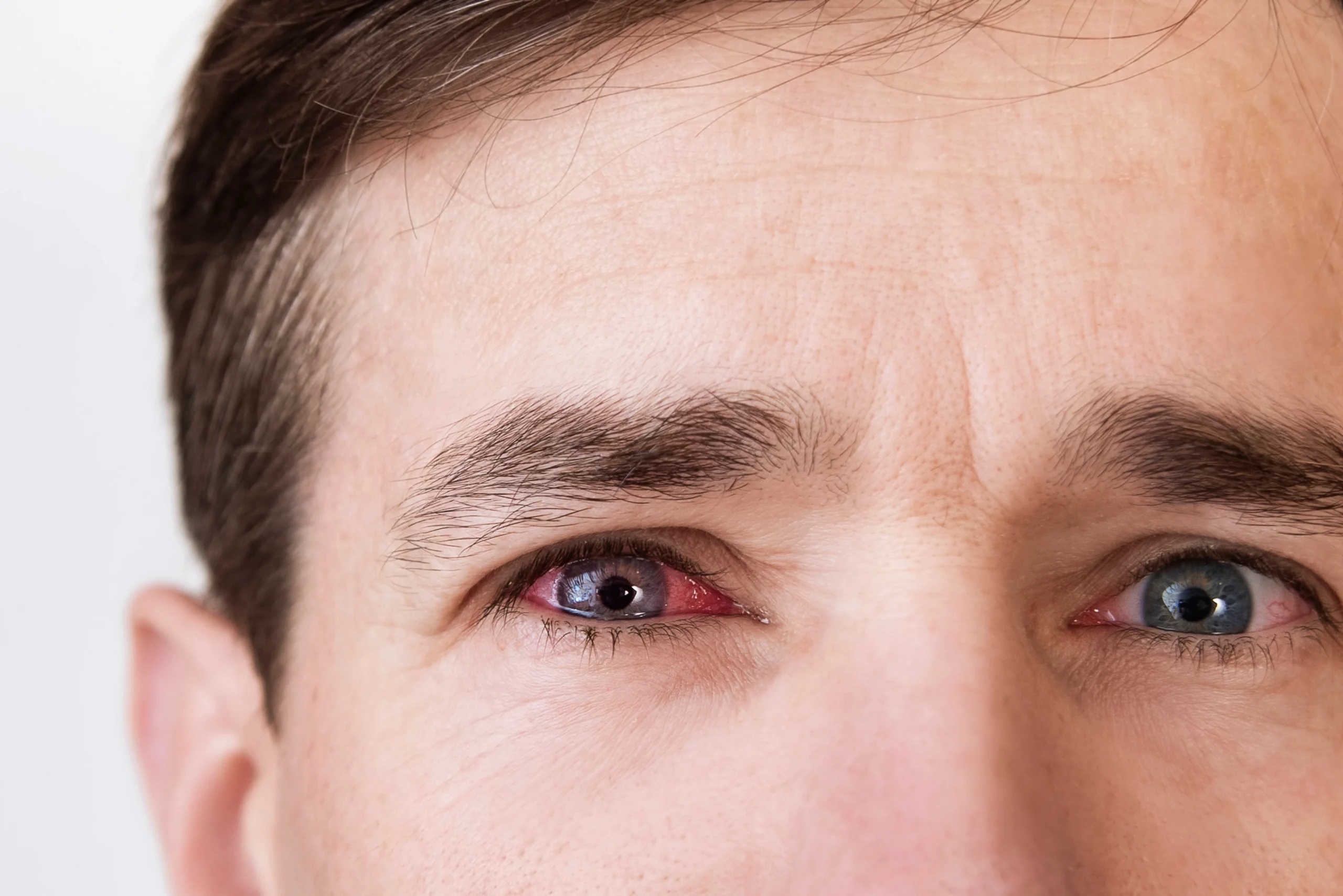 A close up picture of a man's dry, irritated eyes.